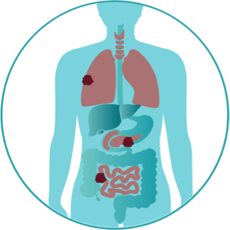 stage four of metastatic melanoma icon